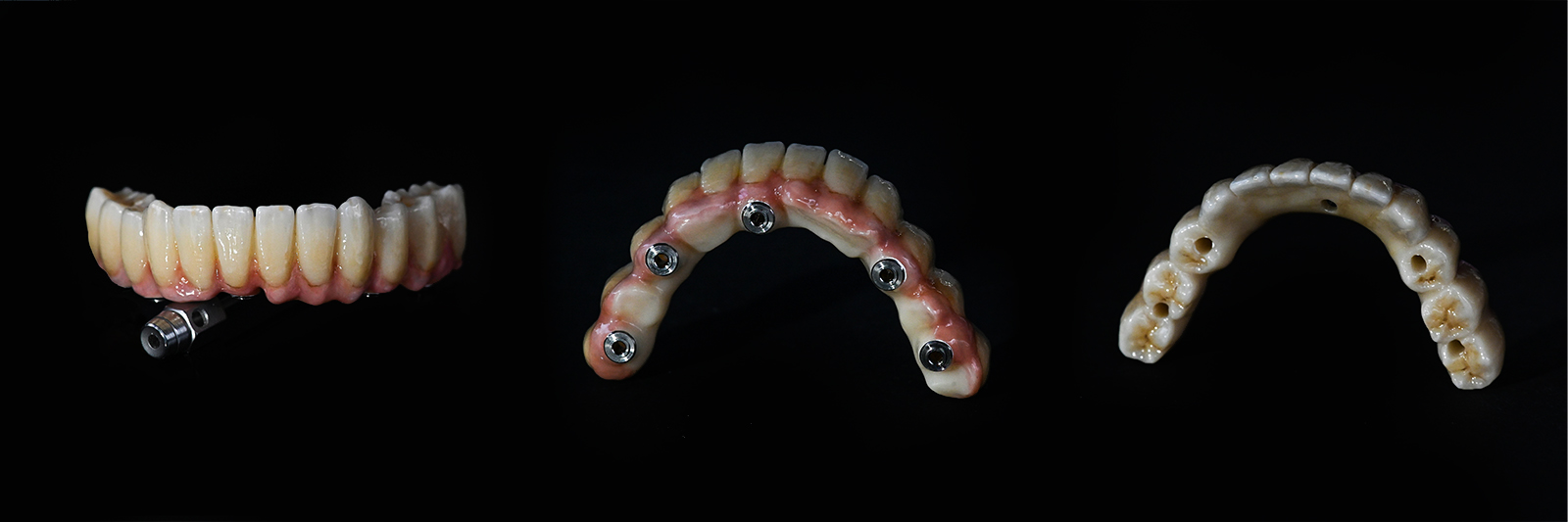 Vollkeramikbrücke auf Implantaten